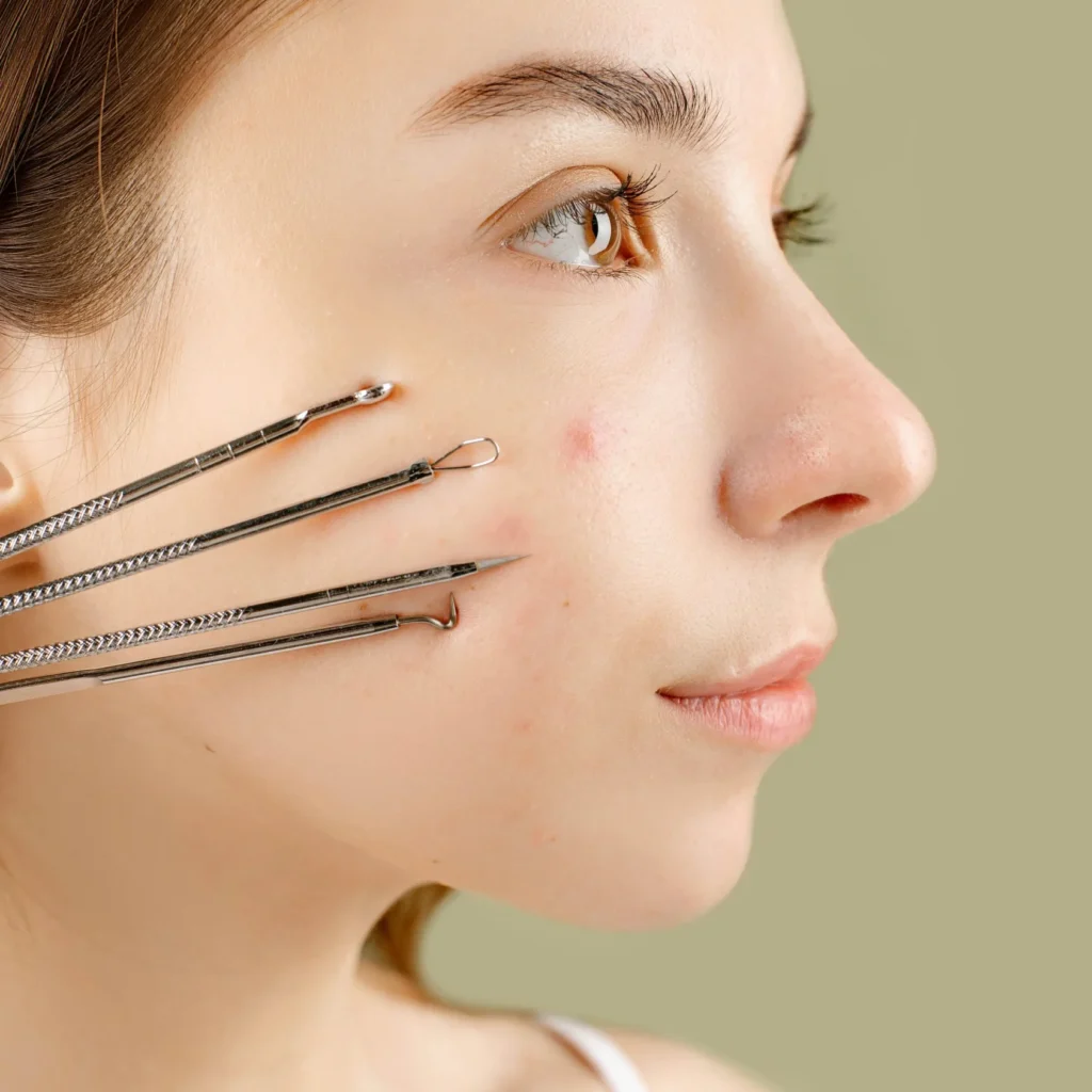Los mejores productos antiacné para la piel acneica.
